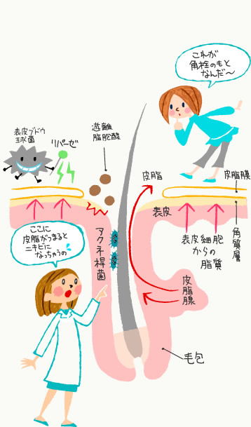 ニキビの要因・図解